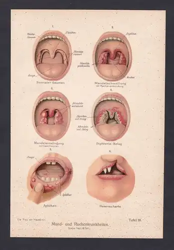 1900 Mund- und Rachenkrankheiten Rachen Krankheit Zunge Lippen Litho Medizin