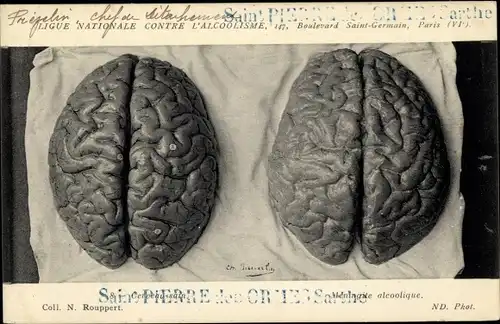 Ak Ligue Nationale contre l'Alcoolisme, Cerveau sain, Meningite alcoolique, Gehirn, Alkoholschäden