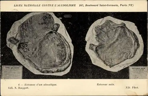 Ak Nationale Liga gegen den Alkoholismus, Magen eines Alkoholikers, gesunder Magen