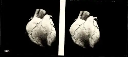 Stereo Foto menschliches Herz, BIKA