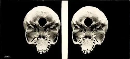 Stereo Foto menschlicher Schädel, Ansicht von unten, BIKA