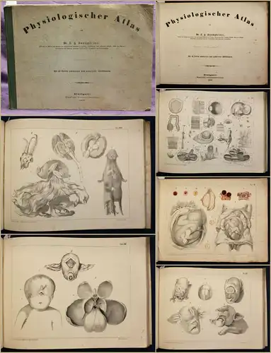 Baumgärtner Physiologischer Atlas 1853 Siamesische Zwillinge Medizin Wissen sf