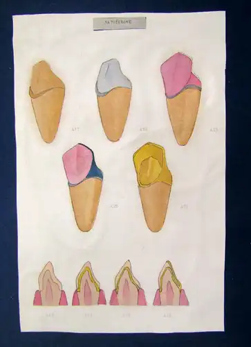 Sammlung 5 Zeichnungen von Zahn - Kronen um 1970 Zahnheilkunde Technik sf