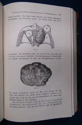 Knapp/ Moos Zeitschrift für Ohrenheilkunde 13.& 14. Band 1884 Medizin Wissen sf