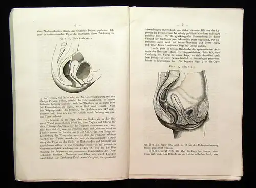 Schultze Über die pathologische Anteflexion der Gebärmutter 1875 Medizin mb