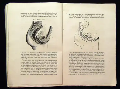 Schultze Über die pathologische Anteflexion der Gebärmutter 1875 Medizin mb