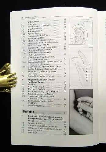 Gleditsch Akupunktur in der Hals-Nasen-Ohrenheilkunde 1997 41 Abbildungen