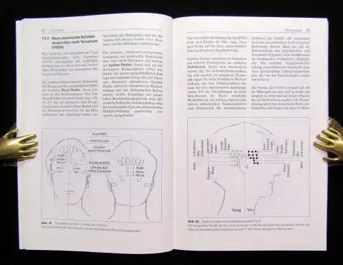 Gleditsch Akupunktur in der Hals-Nasen-Ohrenheilkunde 1997 41 Abbildungen