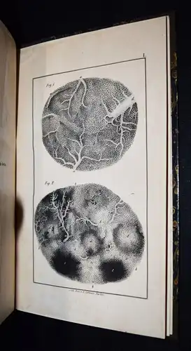 Budd, Die Krankheiten der Leber 1846 - INNERE MEDIZIN GASTROENTEROLOGIE