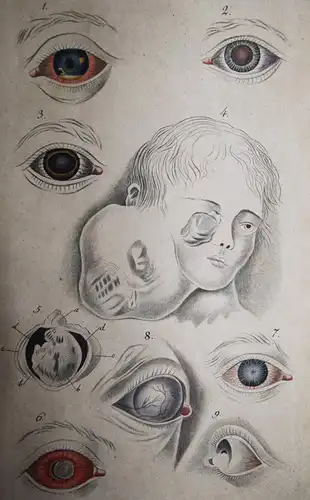 Weller, Die Krankheiten des menschlichen Auges 1826 AUGENHEILKUNDE OPHTHAMOLOGIE