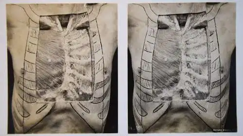 STEREOPHOTOGRAPHIE Waterston, The Edinburgh Stereoscopic Atlas of Anatomy THORAX