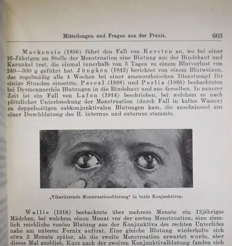 Dallos, Haftgläser und Kontaktschalen 1933 KONTAKTLINSEN OPTIK AUGENHEILKUNDE