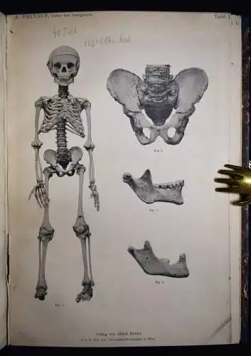 Paltauf, Über den Zwergwuchs in anatomischer und... 1891 KLEINWÜCHSIGKEIT