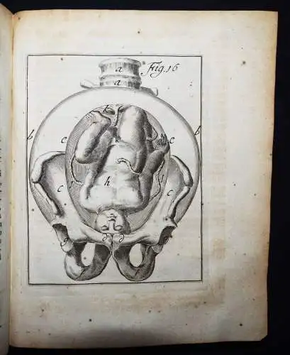 Deventer, Operationes chirurgicae...exhibentes obstetricanti 1701 GYNÄKOLOGIE