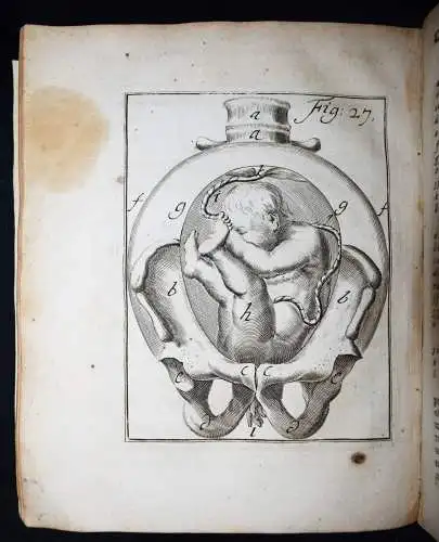 Deventer, Operationes chirurgicae...exhibentes obstetricanti 1701 GYNÄKOLOGIE