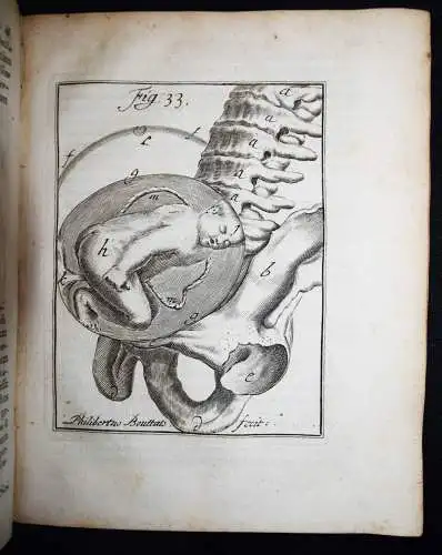 Deventer, Operationes chirurgicae...exhibentes obstetricanti 1701 GYNÄKOLOGIE