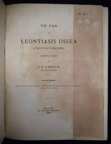 Daniels, Un cas de Leontiasis ossea - 1883 CHIRURGIE MISSBILDUNGEN