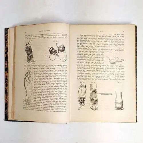 Buch: Praktische Handbuch der Chirurgie, 2 Bde, J. E. Erichsen, 1864, Hirschwald