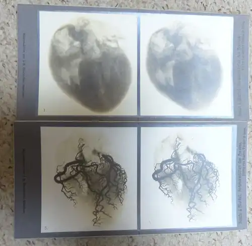 Stereoskopische Röntgenbilder "Die Koronararterien des menschlichen Herzens"