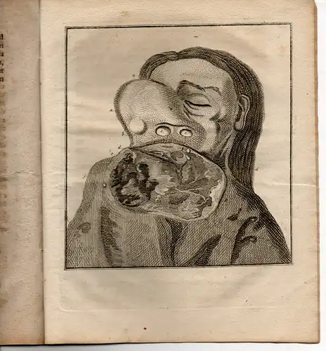 Tittmann, Friedrich Jacob: aus Dresden: Medizinische Dissertation. Osteo-steatomatis casus rarioris (Über einen seltenen Fall von Knochen-Stoffwechselstörungen). 