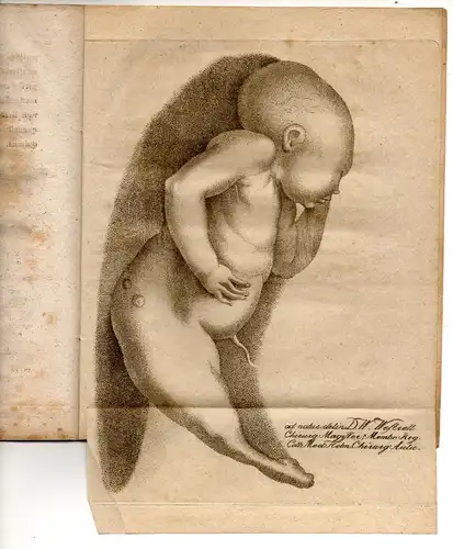 Rossi, Franz Josef Anton: aus Holma: Medizinische Inaugural-Dissertation. Foetus monstrosi Holmiae nati descriptionem et delineationem. 