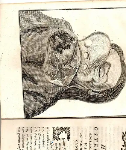 Tittmann, Friedrich Jacob: aus Dresden: Medizinische Inaugural-Dissertation. Osteo-steatomatis casus rarioris. Beigebunden: Christian Gottlieb Ludwig: Observata in sectione cadaveris feminae cujus ossa emollita erant. Promotionsankündigung von Tittmann. 