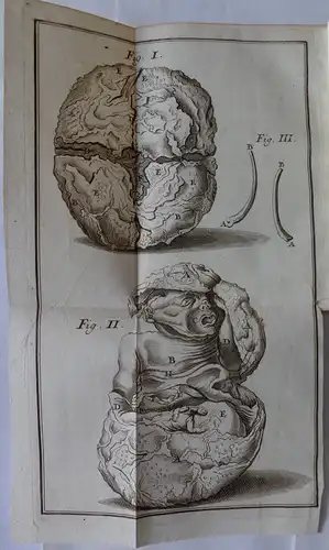 Orth, Georg Friedrich: aus Regensburg: Medizinische Inaugural-Dissertation. De foetu XLVI annorum. 