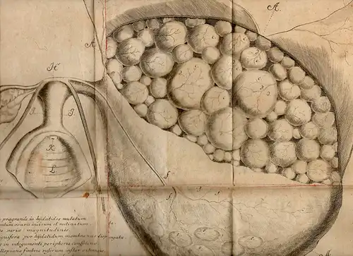 Moebius, Johann Gotthelf aus Leisnig/Sachsen: Medizinische Inaugural Dissertation. De virgine ascitica post paracenthesin purpura maligna exstincta (Über eine bauchwassersüchtigen jungen Frau nach Öffnung des Bauches.. 