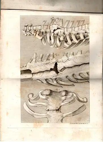 Haugk, Friedrich: aus Zwickau: De fractura sterni et vertebratum. Dissertation. 