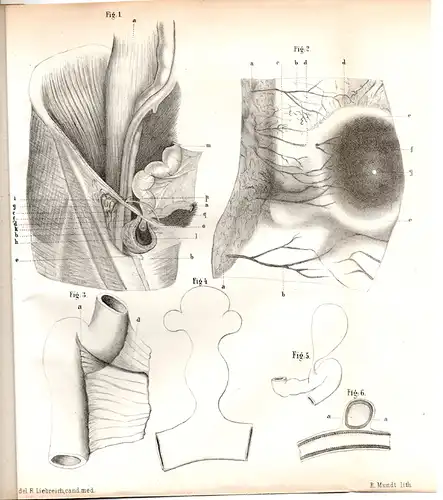 Raesfeld, Albert von: aus Bocholt: De hernia littrica. Dissertation. 