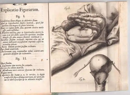 Pistor, Christian Friedrich: aus Stuttgart: Medizinische Inaugural-Dissertation. Foetum erupto utero in abdomen prorumpentem. 
