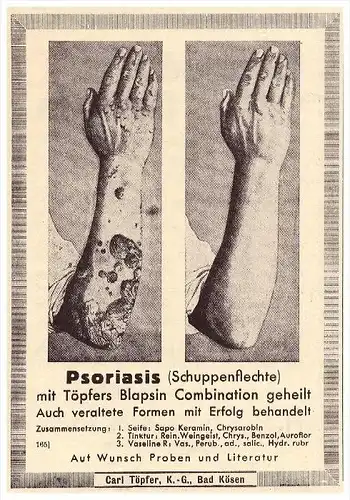 original Werbung - 1937 - Carl Töpfer in Bad Kösen , Schupenflechte , Psoriasis , Arzt , Krankenhaus , Apotheke