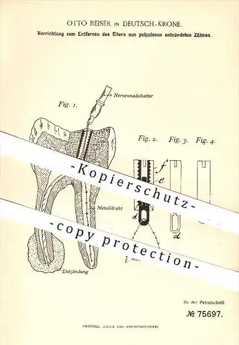 original Patent - Otto Reiser in Deutsch - Krone , 1893 , Entfernen von Eiter aus Zähnen , Zahn , Zähne , Zahnarzt !!!