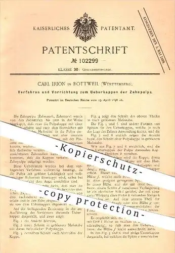original Patent - Carl Irion , Rottweil , 1898 , Überkappen der Zahnpulpa , Zahnnerv , Zahn , Zähne , Zahnarzt , Medizin