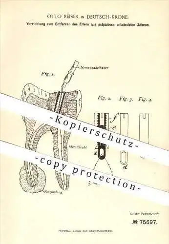 original Patent - Otto Reiser in Deutsch - Krone , 1893 , Entfernen von Eiter aus Zähnen , Zahn , Zähne , Zahnarzt !!!