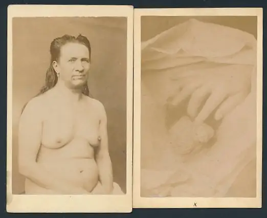 2 Fotografien 1874, Hermaphrodit, Portrait Person mit männlichen und weiblichen Geschlechtsmerkmalen 0