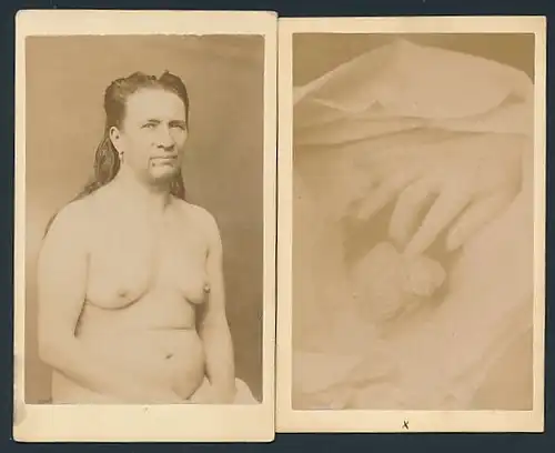 2 Fotografien 1874, Hermaphrodit, Portrait Person mit männlichen und weiblichen Geschlechtsmerkmalen