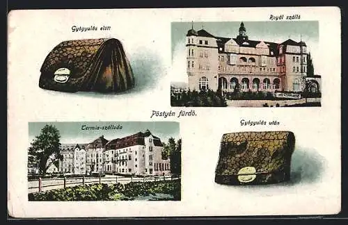 AK Pöstyen, Termia-szalloda, Royal szallo