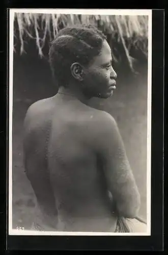 Fotografie Leopold Gabriel, Katanga, Kongolesische Frau mit Skarifizierug auf Rücken und Armen