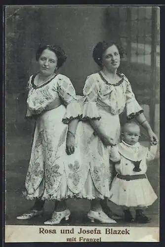 AK Siamesische Zwillingen Rosa und Josefa Blazek mit Franzel, Behinderte