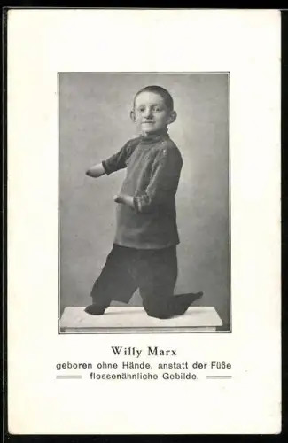 AK Willy Marx, geboren ohne Hände, flossenähnliche Gebilde anstatt der Füsse