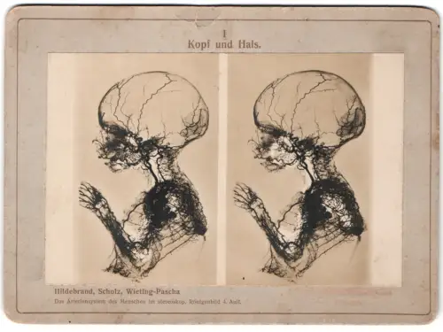 5 Stereo-Fotografien Wieting-Pascha, Hildebrand, Scholz, Das Arteriensystem des Menschen im stereoskop. Röntgenbild